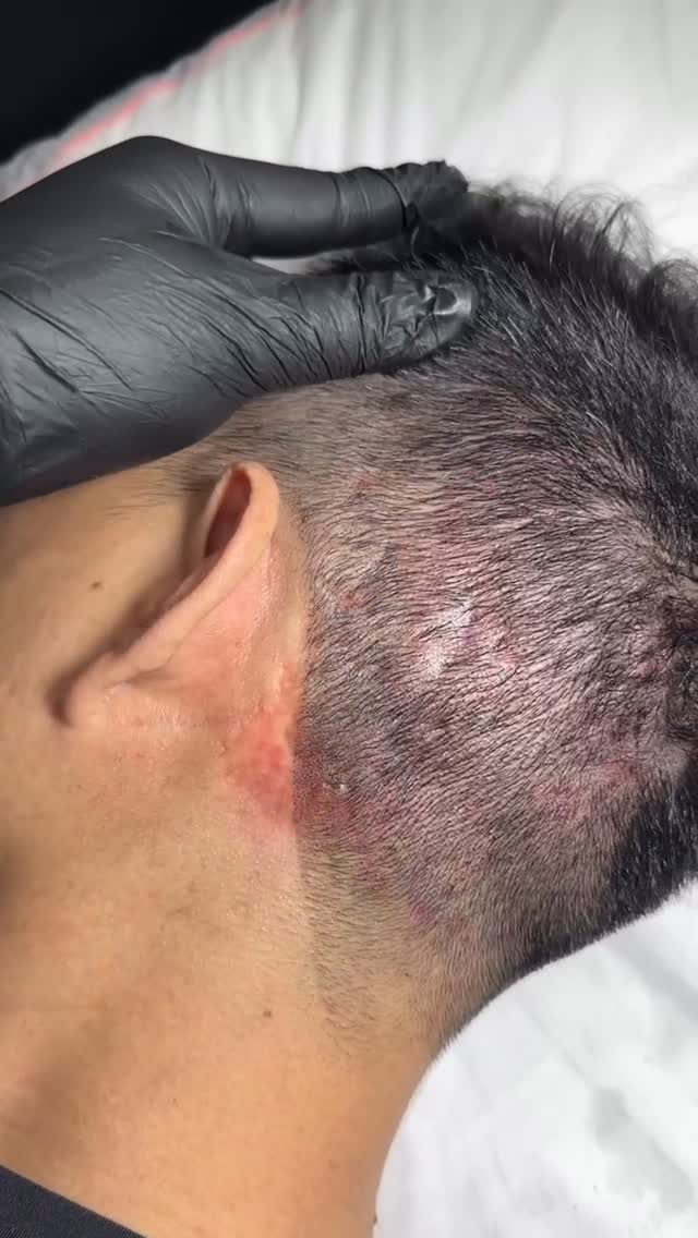 Xăm tóc , che tóc rụng , tạo chân tóc !TÙNG LÊ TATTOO STUDIO#0906-306-109 #0799-080-090ADDRESS : - 156/7A1 ,Tô Hiến Thành,Phường Hoà Hưng, Quận 10,TP.