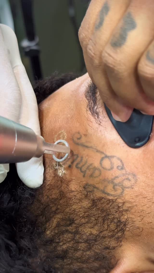 #wastattoo #remocaoalaser #remoçãodetatuagem #remoção #remoçãoalaser