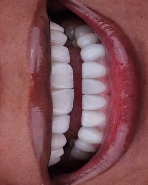 Monolíticos/Maquillaje