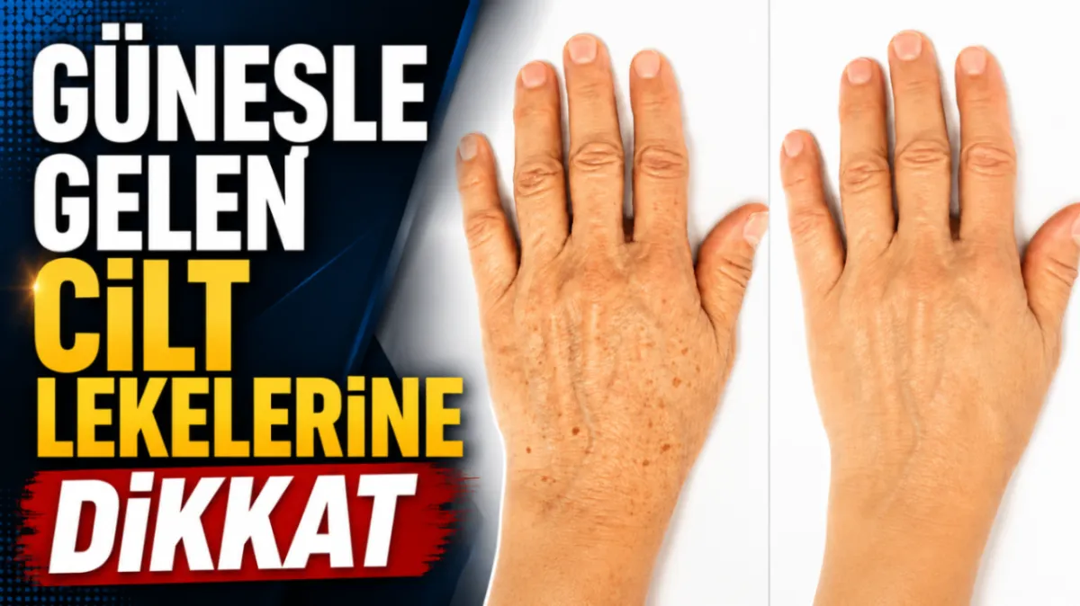 Güneşle gelen cilt lekelerine dikkat