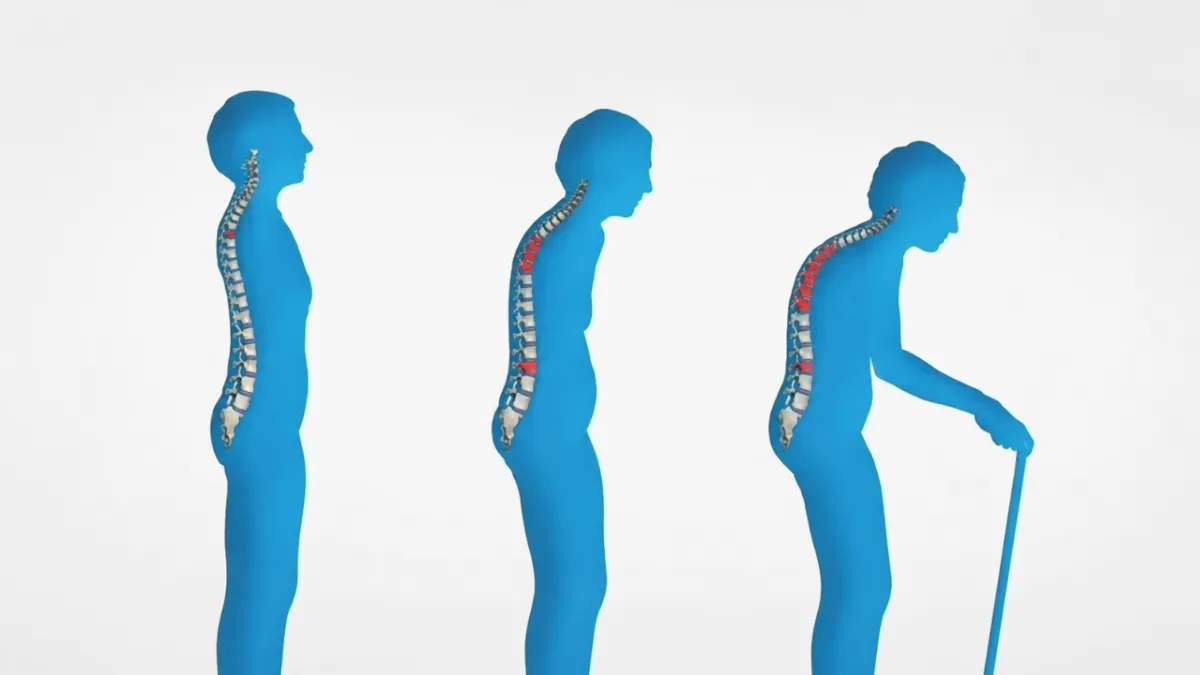 Sessiz ilerleyen hastalık osteoporoz  