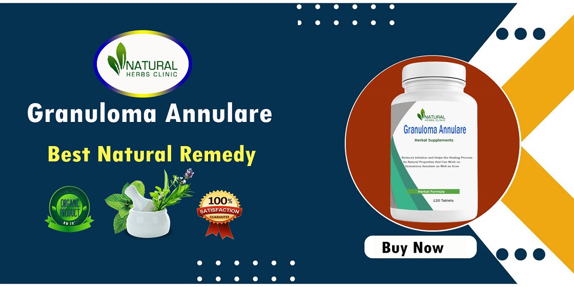 Home Remedies for Granuloma Annulare