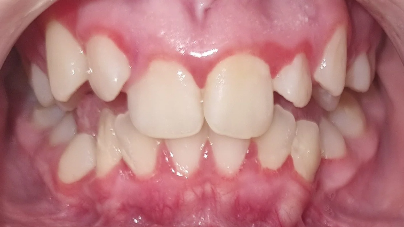 Otvoreni zagriz, labijalno postavljeni očnjaci, gingivitis