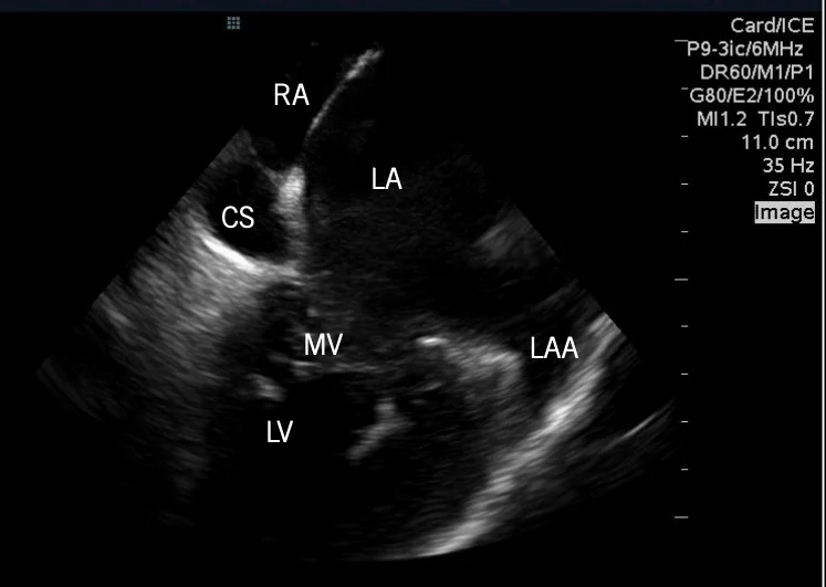 Intracardiac Echocardiography (ICE)