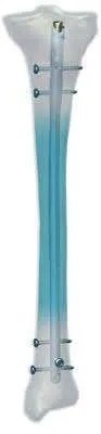 DePuy Synthes TI Cann Tibial Nail-EX, 11 mm, with Prox Bend, 300 mm, Sterile, Each