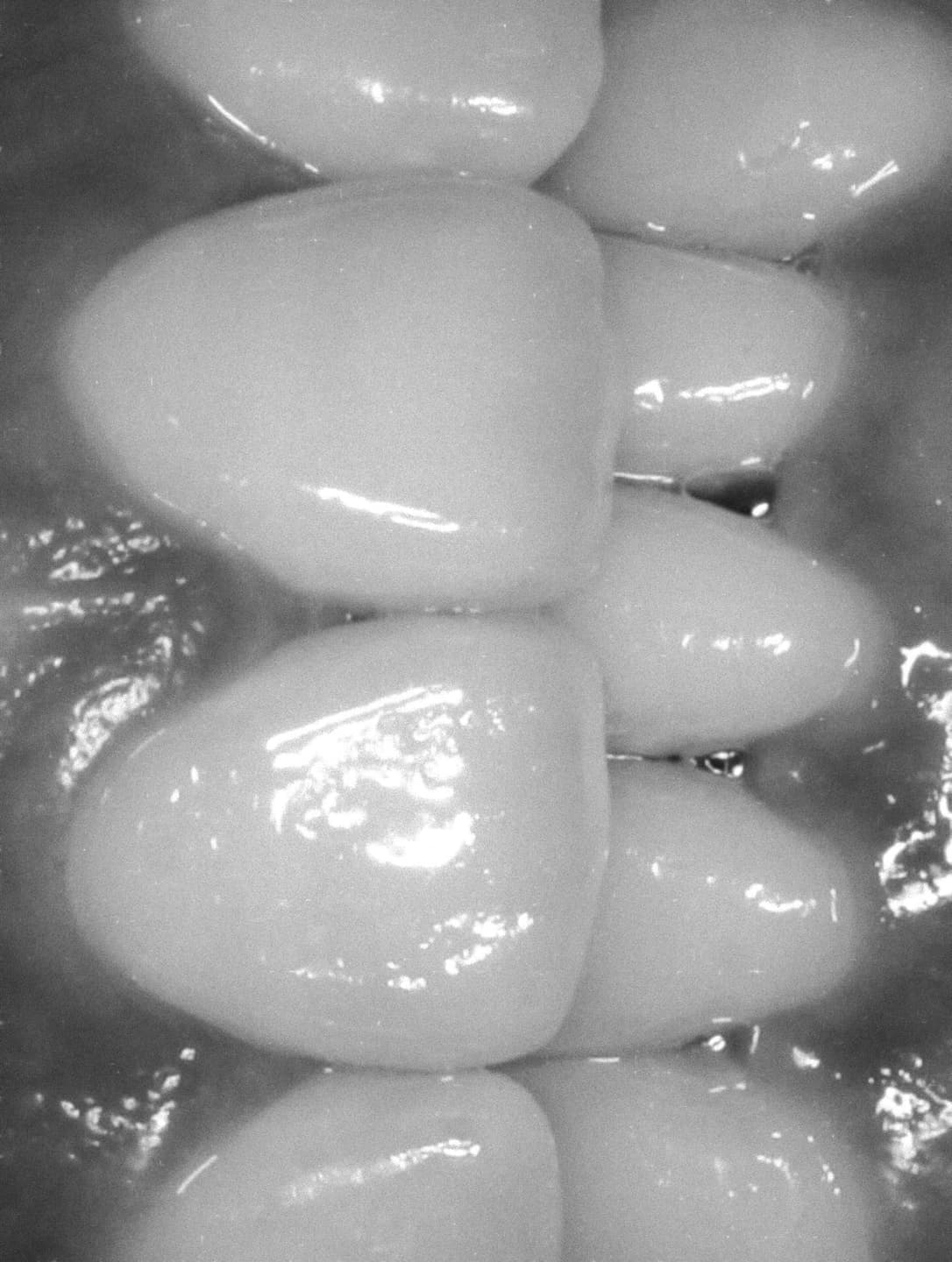 My Invisalign 3
