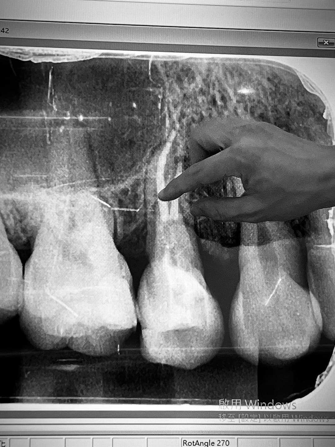 My Invisalign 4