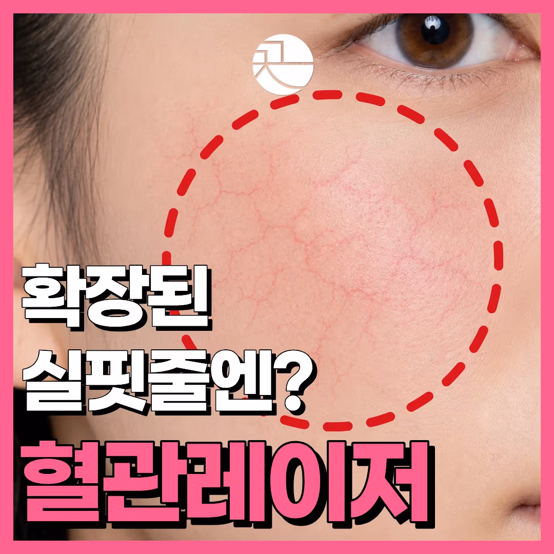 [보기 싫은 확장된 혈관엔?] 실핏줄 혈관레이저