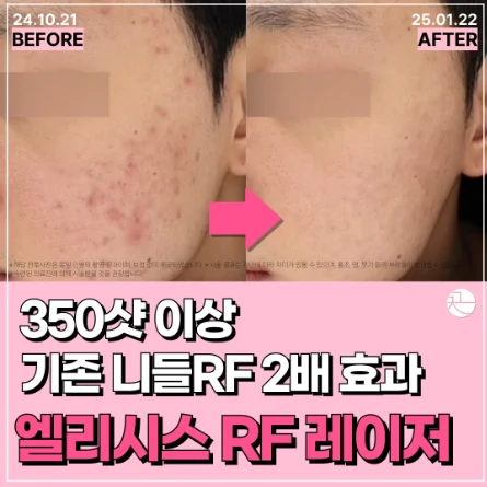 [기존 니들RF 2배 효과, 모공, 여드름 흉터] 엘리시스 RF 레이저