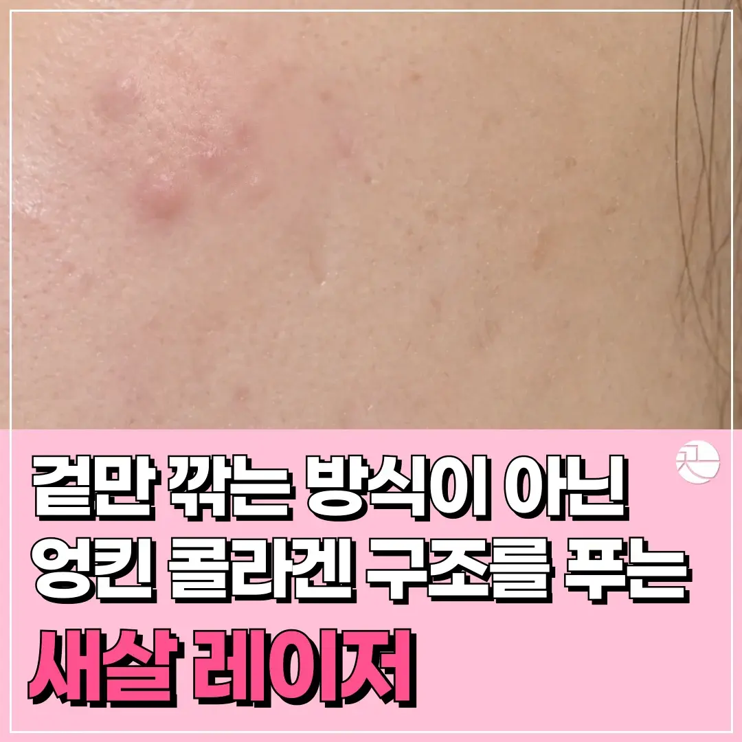 [볼록한 비후성 흉터 : 화상, 수술, 여드름 등] 새살레이저