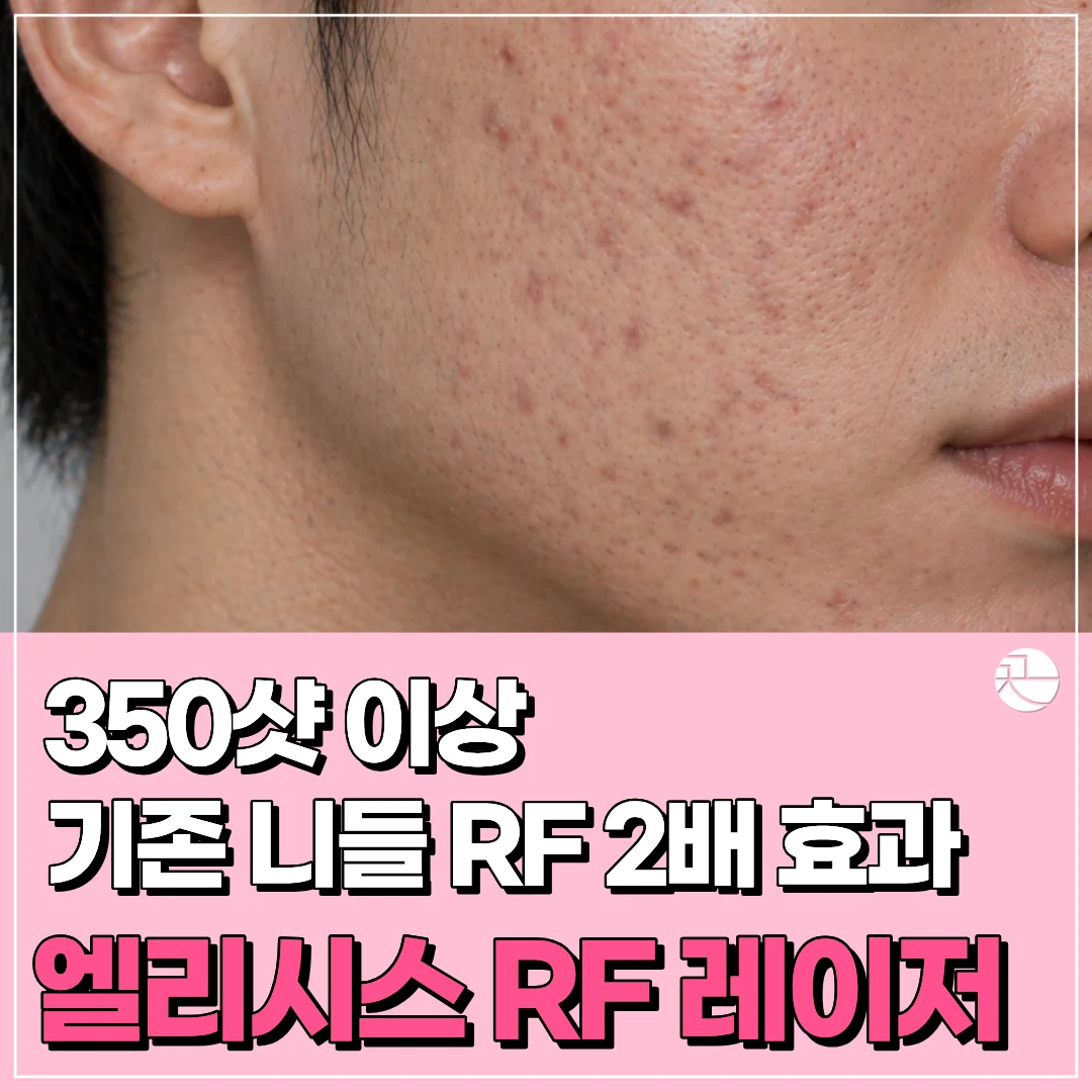 [기존 니들RF 2배 효과, 모공, 여드름 흉터] 엘리시스 RF 레이저