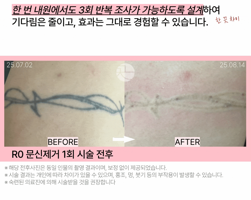 [한 번의 시술로 3회 레이저 조사] R0 타투 문신제거