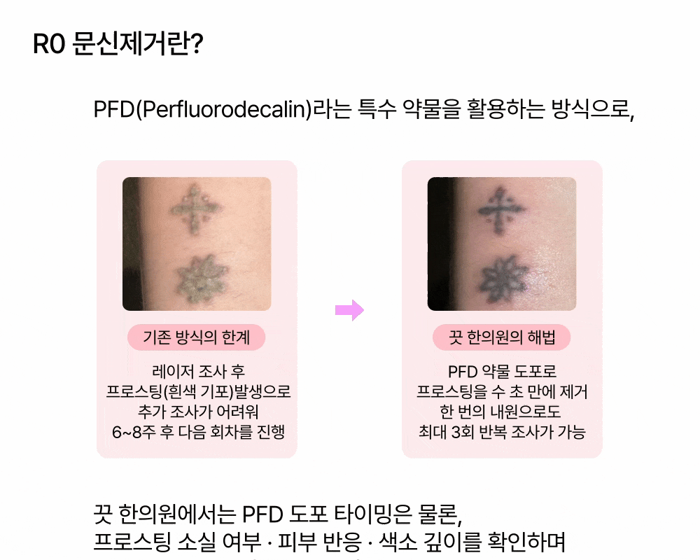 [한 번의 시술로 3회 레이저 조사] R0 타투 문신제거