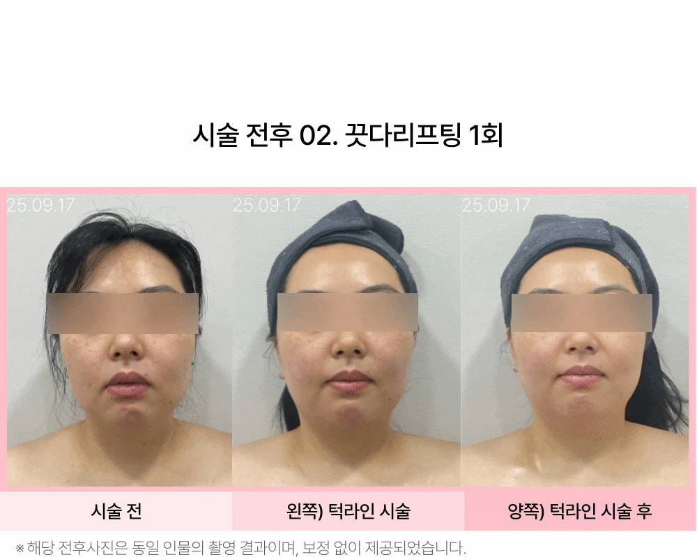 마이크로웨이브 끗다 리프팅 상세 이미지