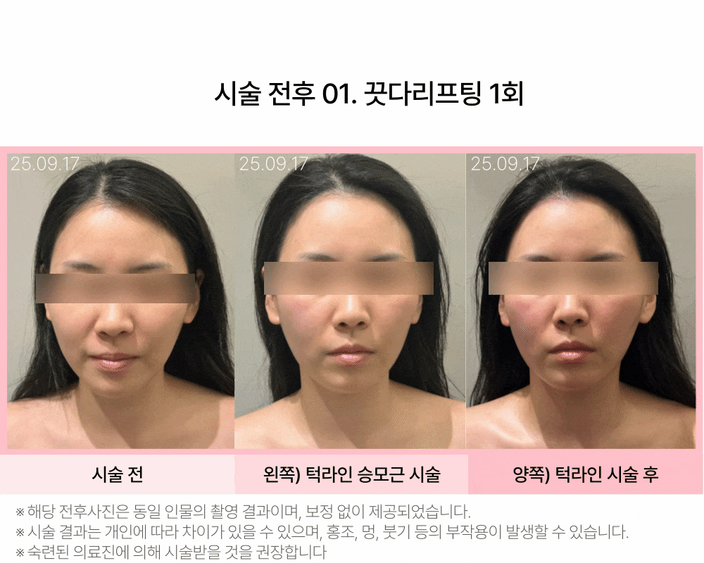 마이크로웨이브 바디 끗다 리프팅 상세 이미지