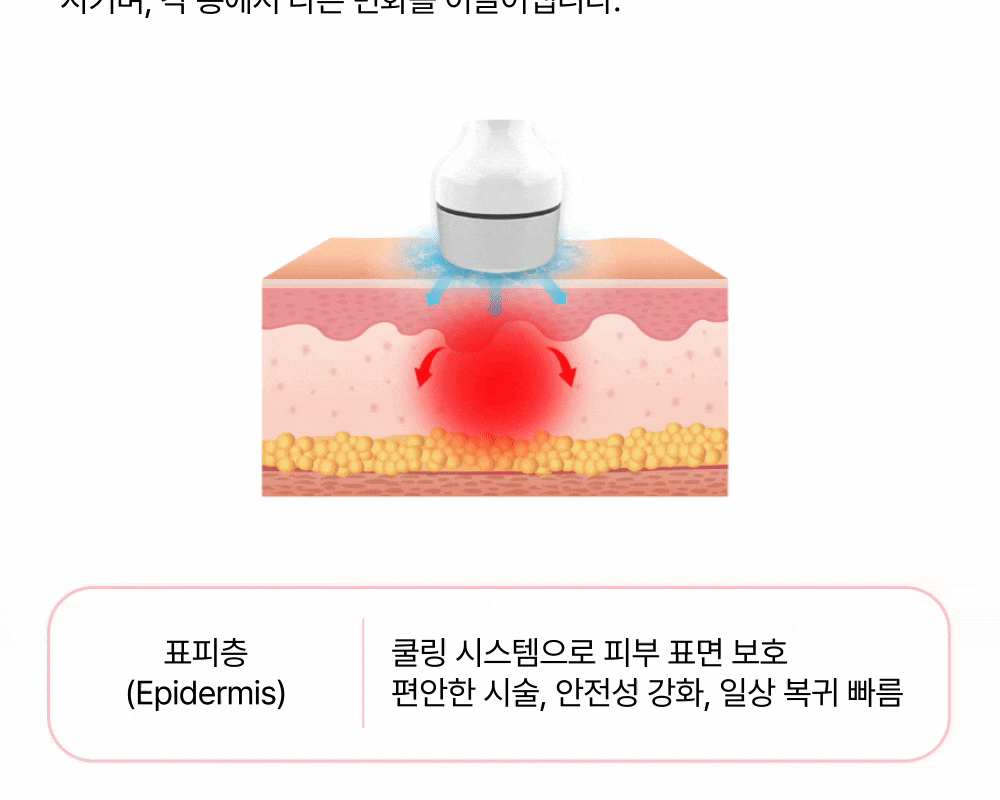마이크로웨이브 바디 끗다 리프팅 상세 이미지
