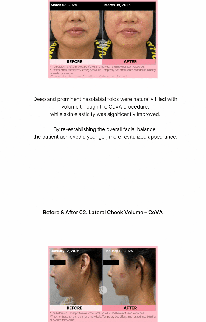 COVA: No-Filler Forehead Lines 상세 이미지