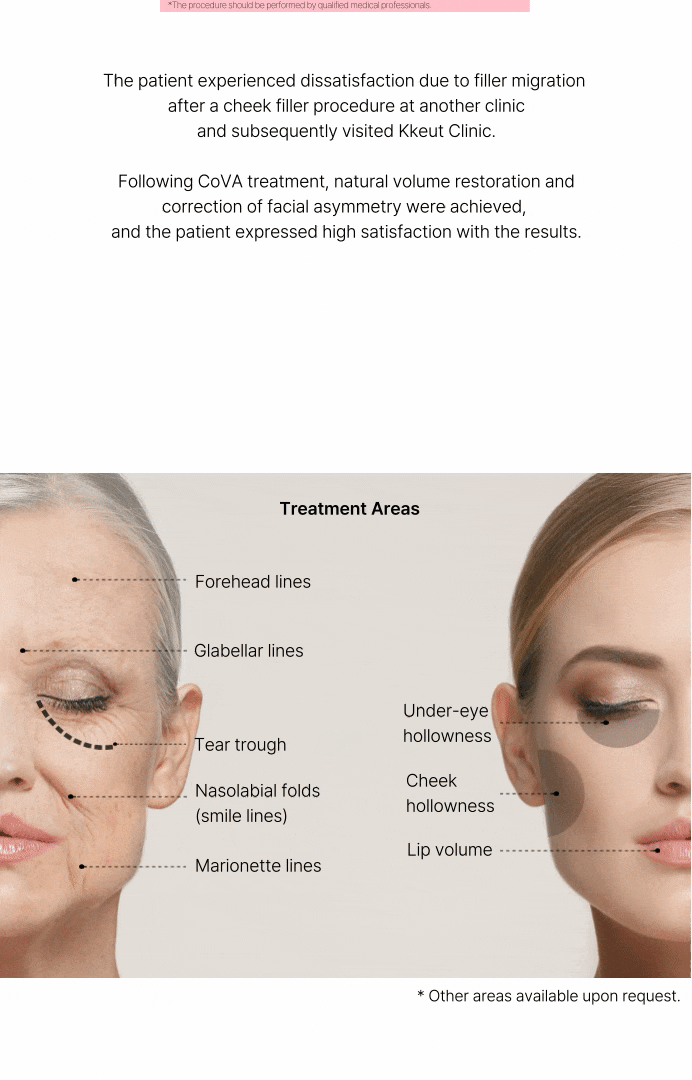 COVA: No-Filler Forehead Lines 상세 이미지