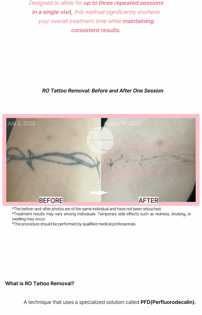 R0 Tattoo Removal: 3x the Effect in 1 Session!