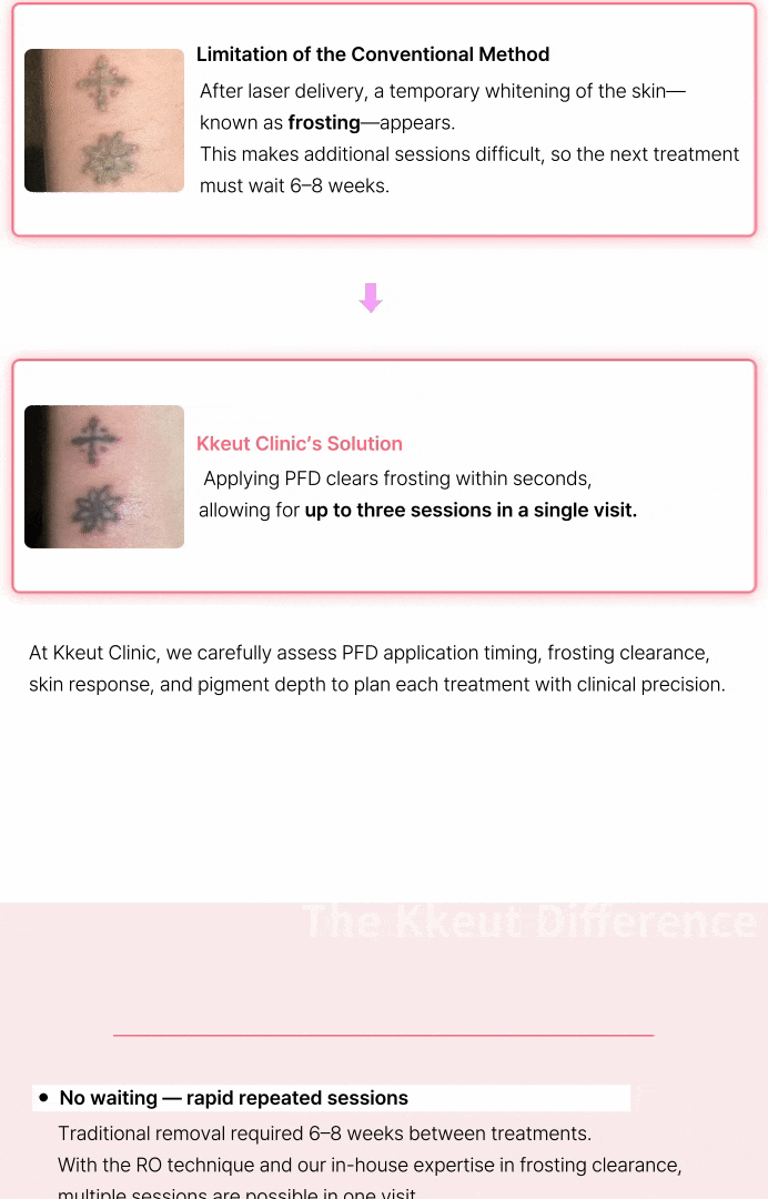 R0 Tattoo Removal: 3x the Effect in 1 Session!