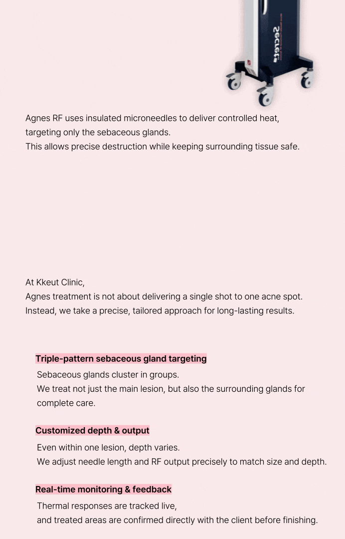 [ニキビの根本原因、皮脂腺破壊] シークレットRFアグネス 상세 이미지