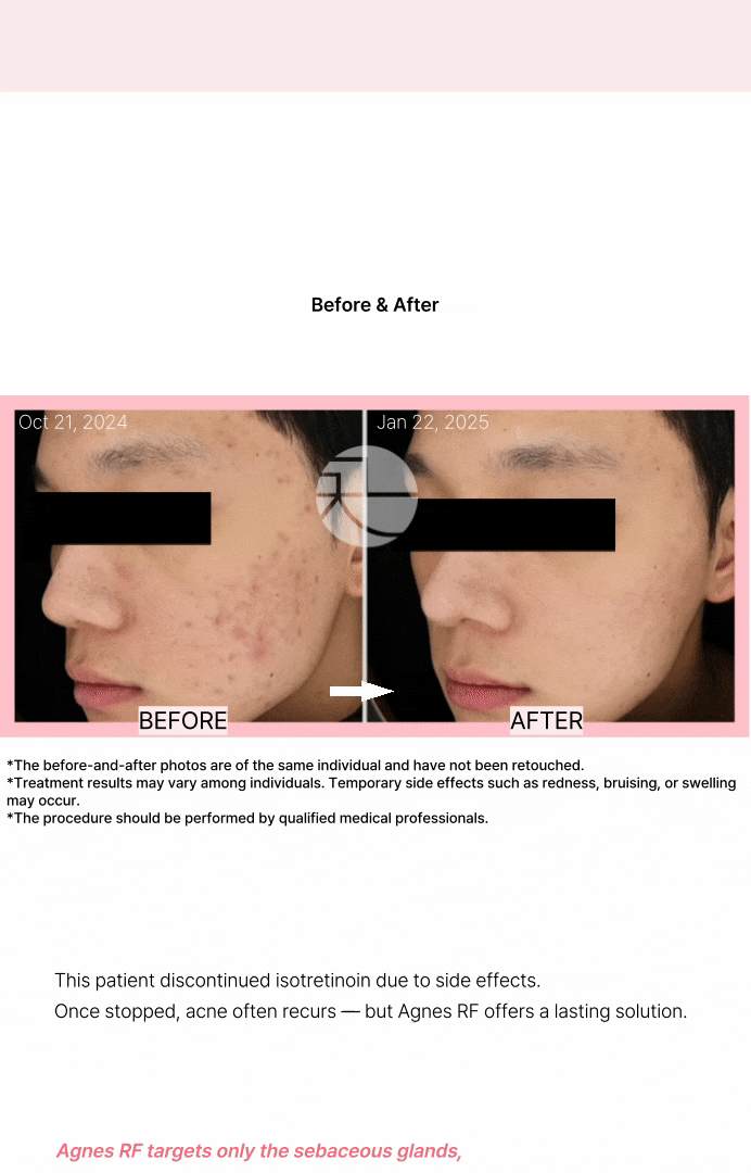 [ニキビの根本原因、皮脂腺破壊] シークレットRFアグネス 상세 이미지