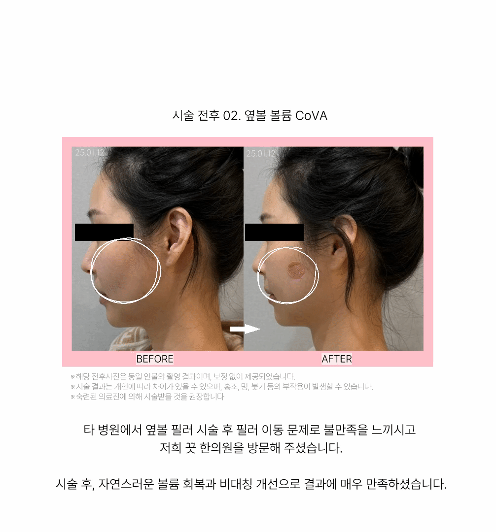 주름필러 no!-이마주름 콜라겐볼륨침 COVA 상세 이미지