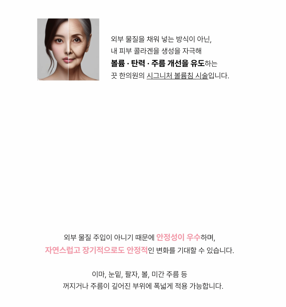 필러no!-마리오네트주름 콜라겐볼륨침 COVA 상세 이미지