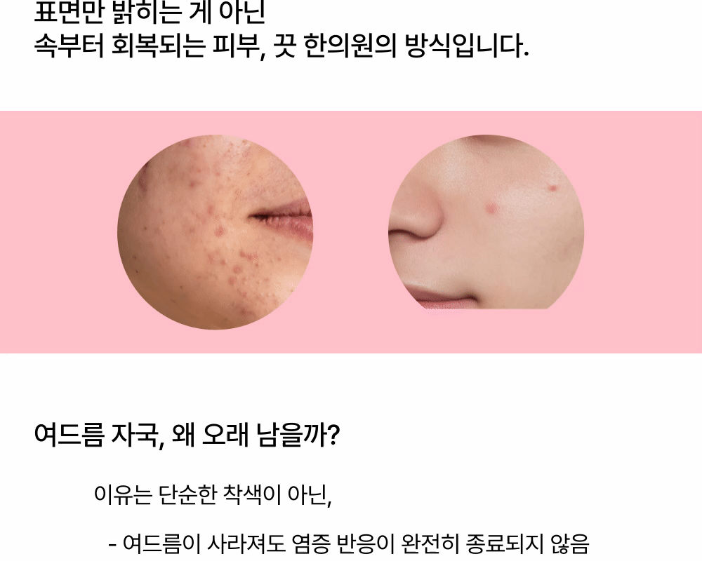 여드름 자국 제거술, 시간이 아니라 이 시술이 약입니다. 상세 이미지