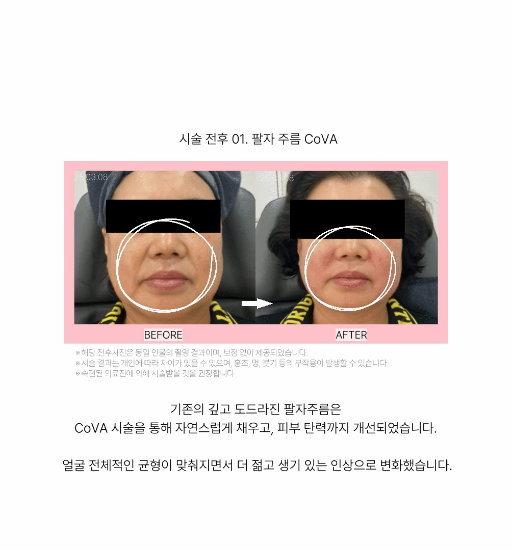입술필러 no!-촉촉 탱탱 입술 내츄럴 틴트침 상세 이미지