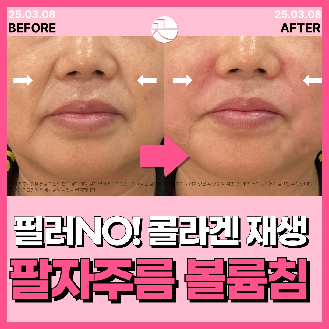 필러no!-팔자주름 콜라겐볼륨침 COVA