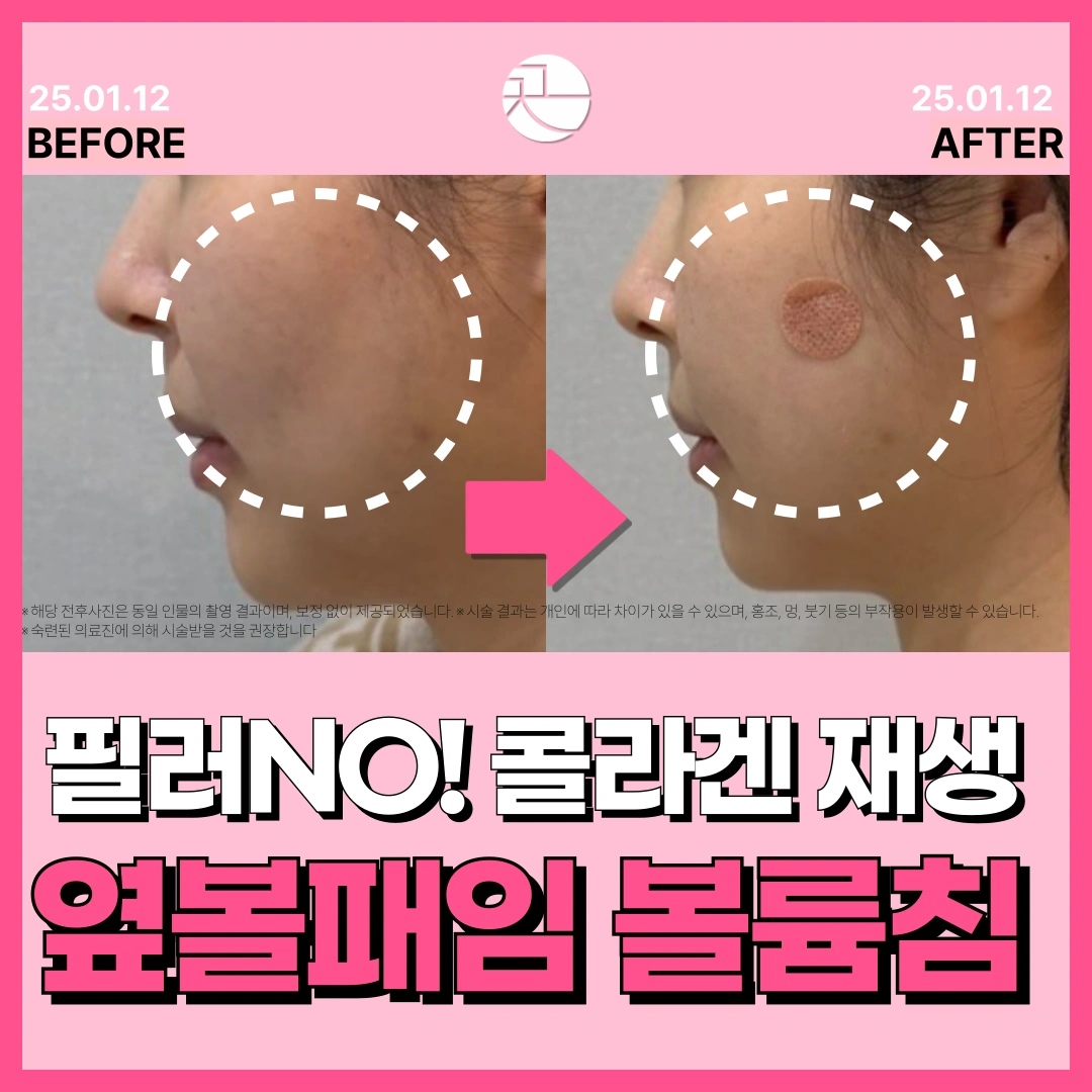 옆볼필러 no!-볼패임 콜라겐볼륨침 COVA