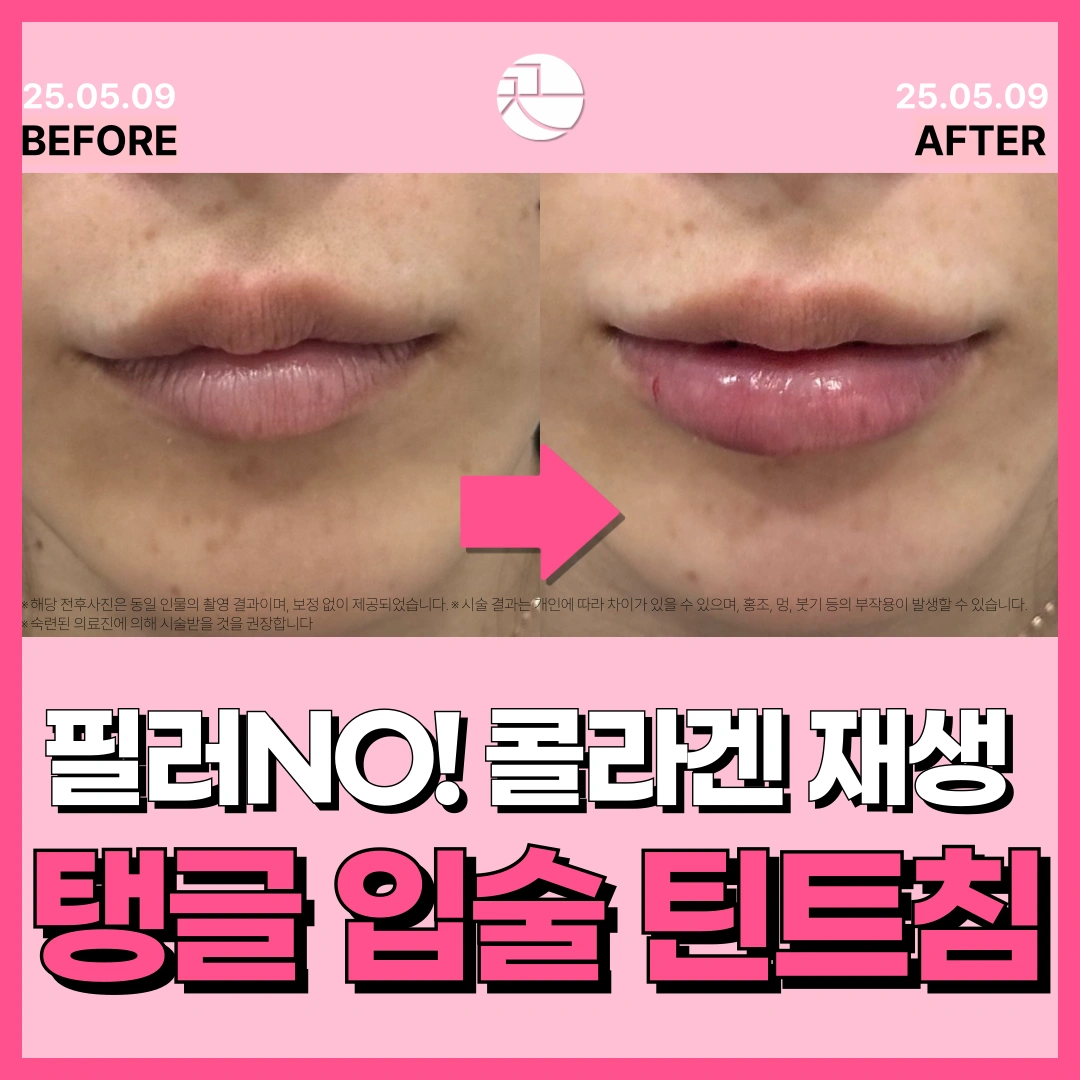 입술필러 no!-촉촉 탱탱 입술 내츄럴 틴트볼륨침