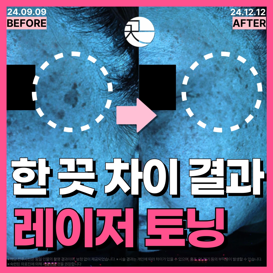  [결과가 같지 않은] 레이저 토닝