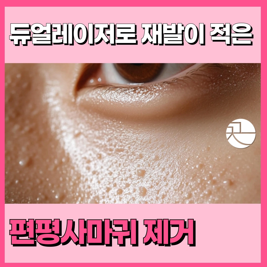  재발 적은 편평사마귀 듀얼레이저 제거