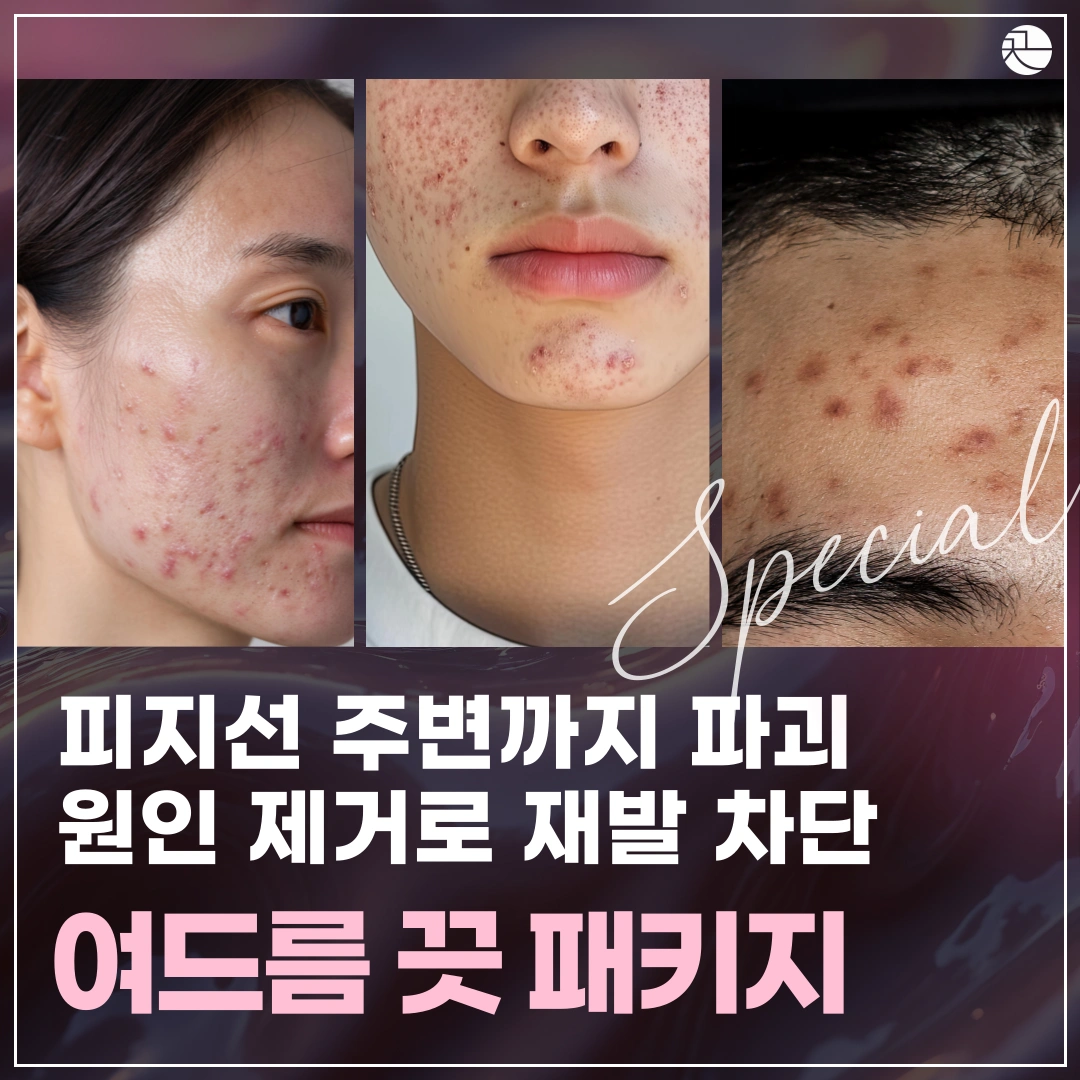 한 끗 다르게, 피지선을 정확히 타격하는 여드름 재발 차단 패키지