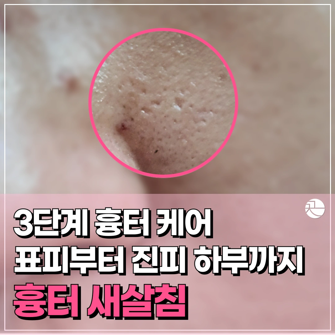 [깊게 패인 흉터를 채우는] 흉터 새살침