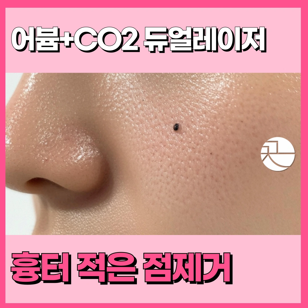 점, 돌출점, 재발 하는 점제거