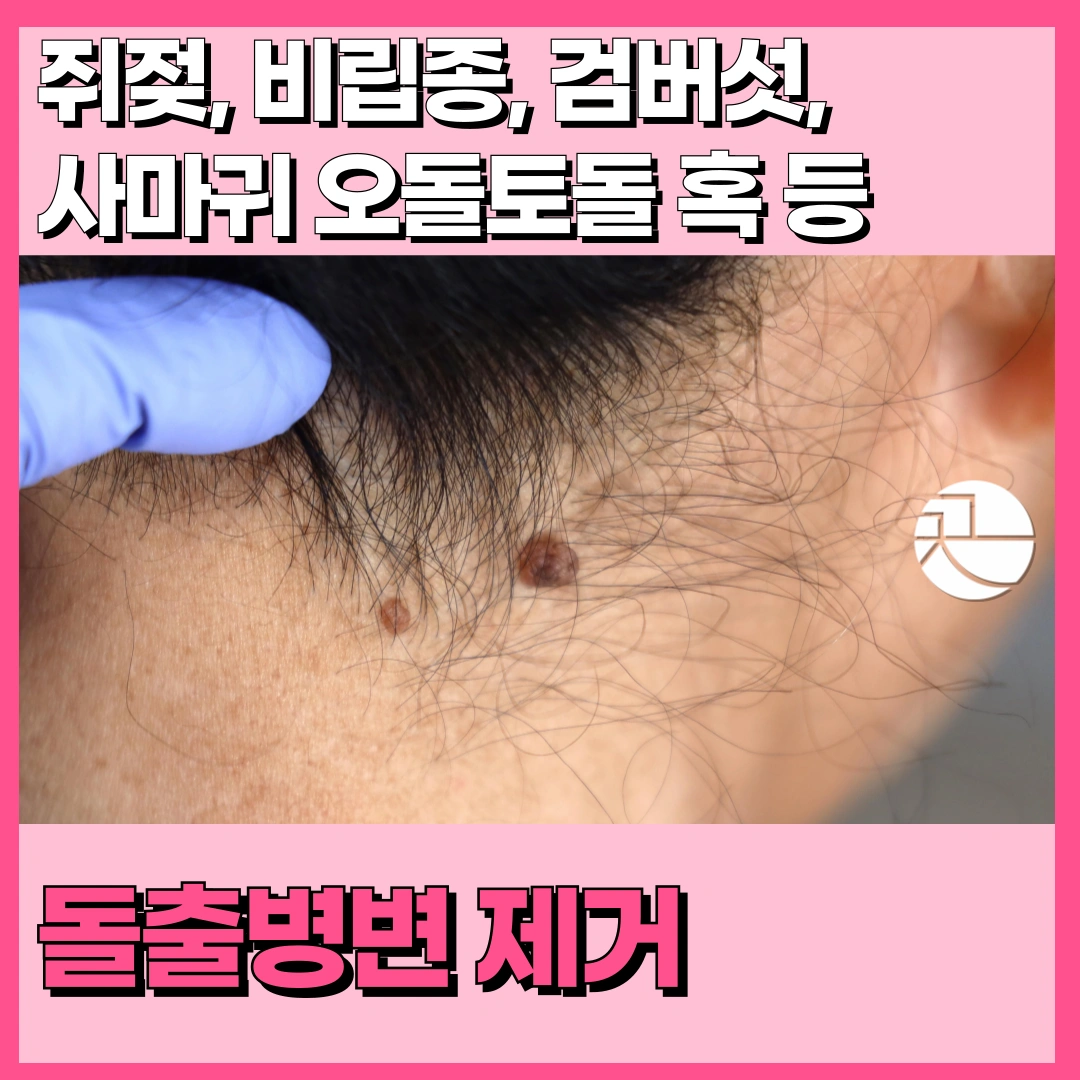 쥐젖, 비립종, 검버섯, 사마귀 등 돌출병변 레이저 제거