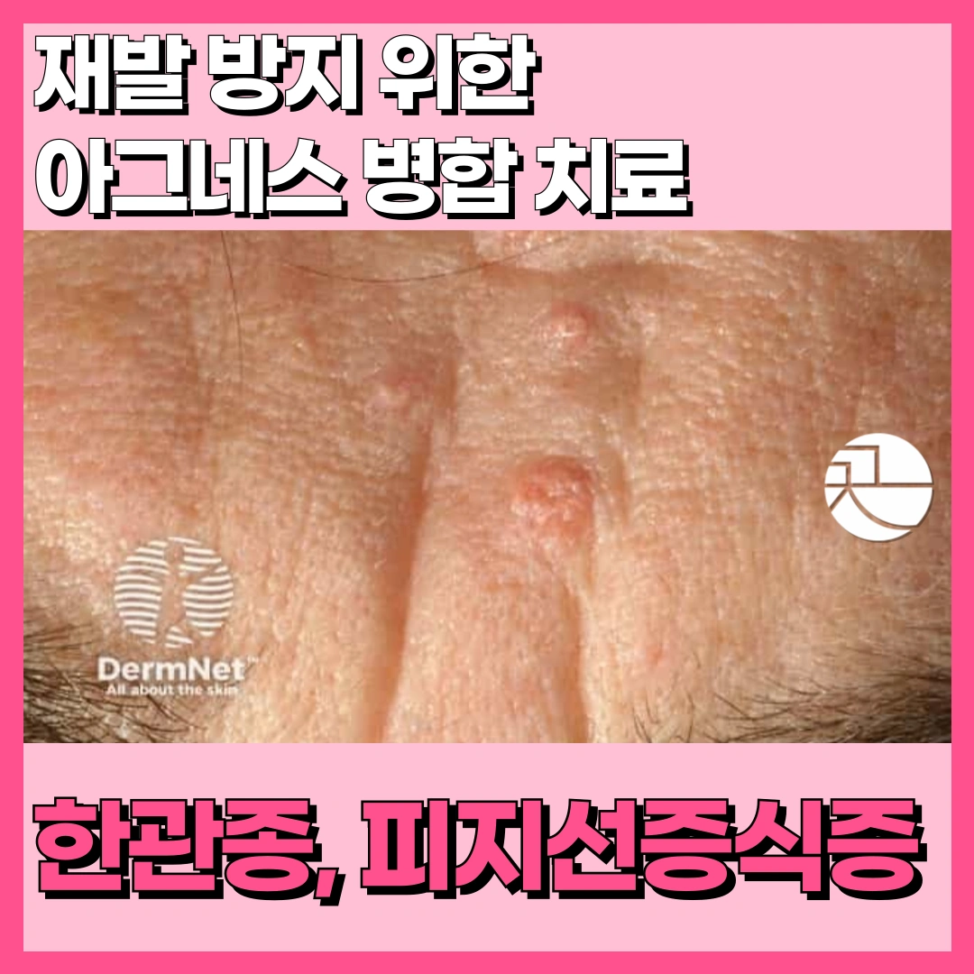 피지선증식증, 한관종 재발 '없이' 치료!