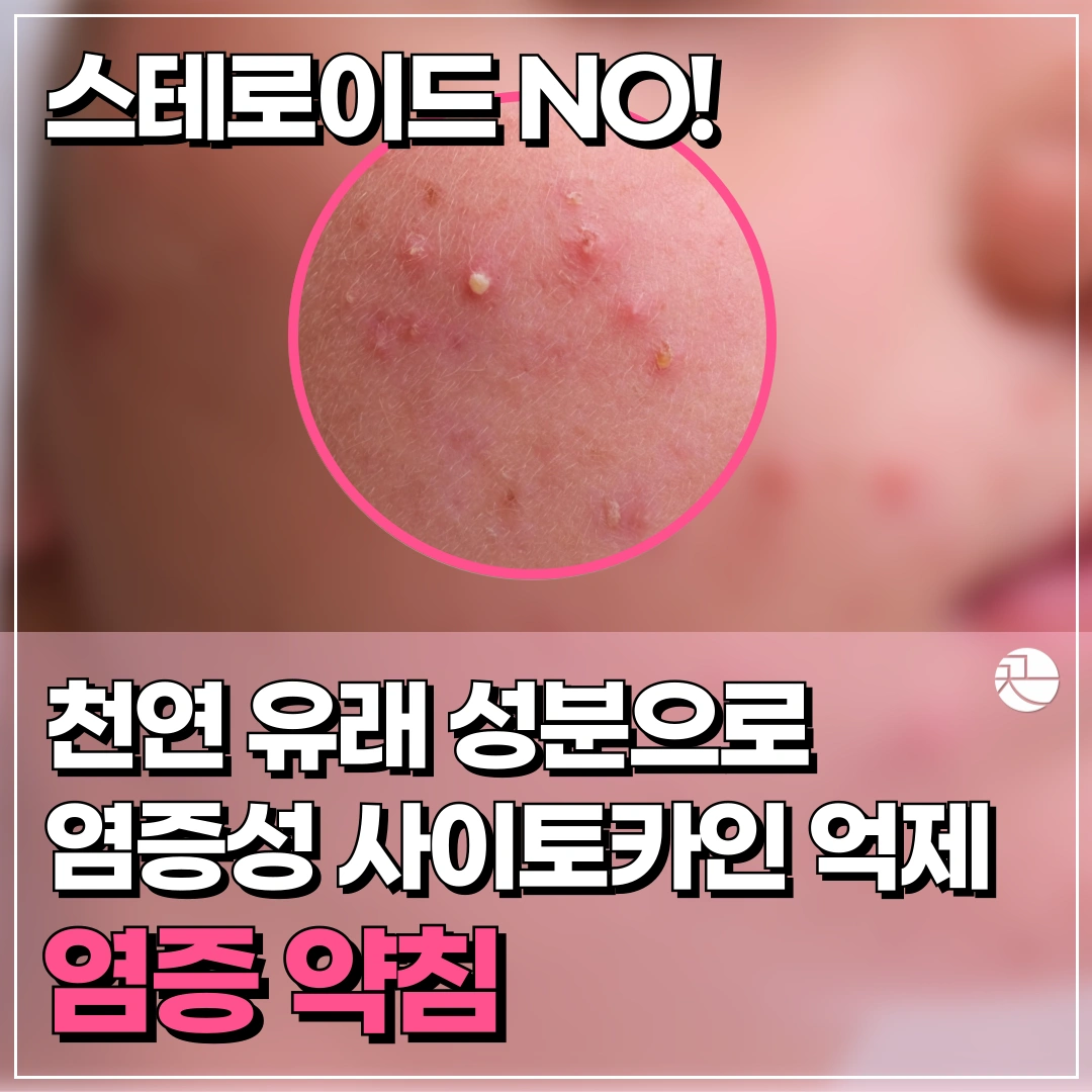 염증주사? 스테로이드 없는 염증 약침