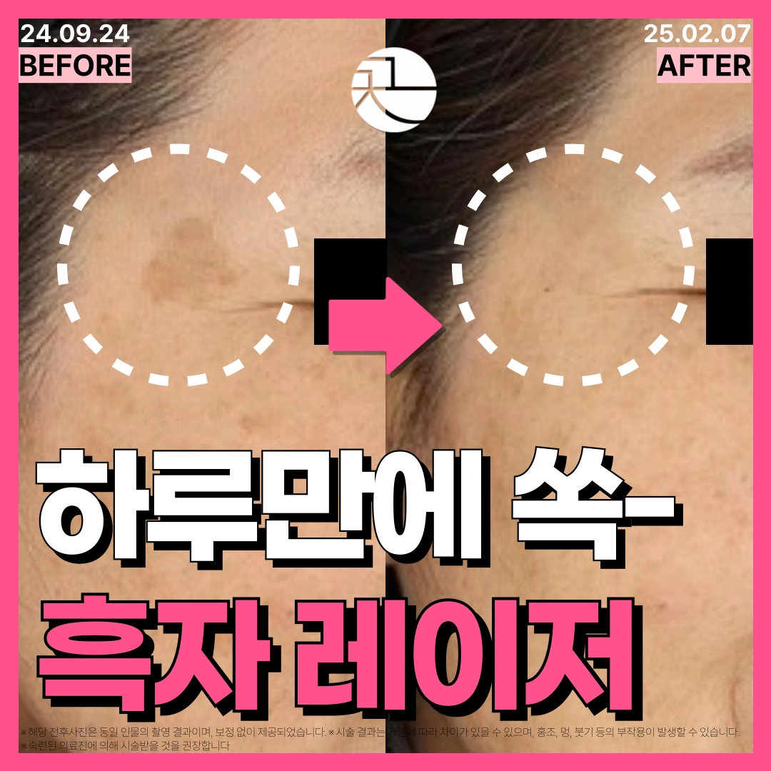 [흑자 쏙 빼는] 흑자 레이저