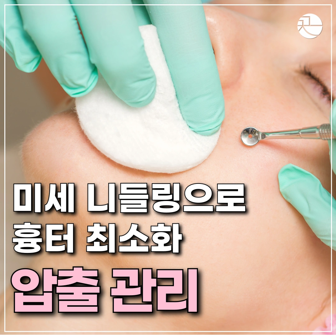 [여드름 치료의 근본] 여드름 압출