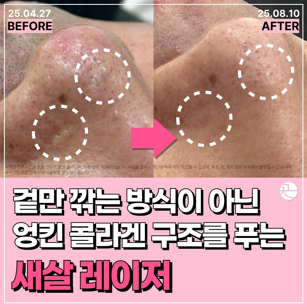 [볼록한 비후성 흉터 : 화상, 수술, 여드름 등] 새살레이저