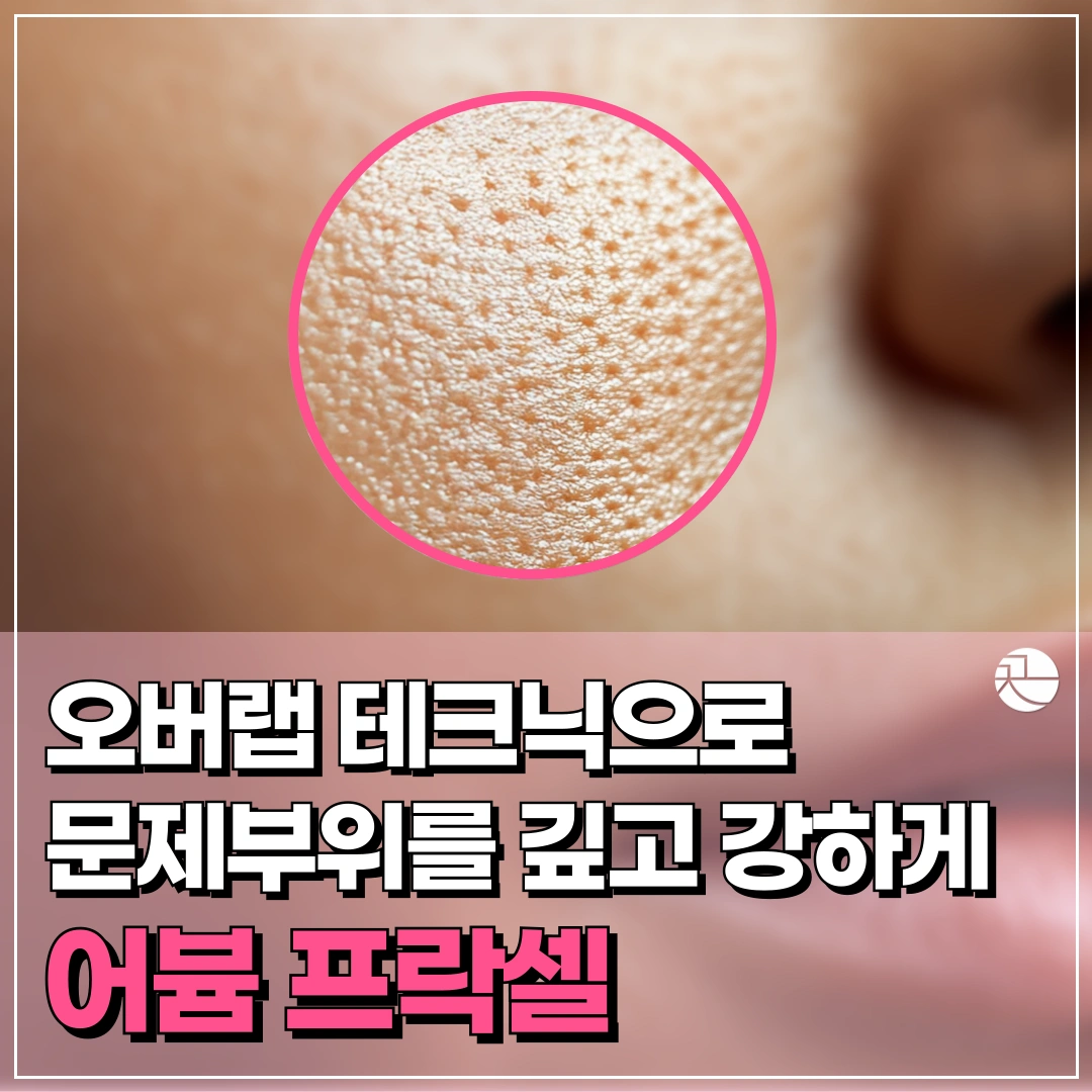 [회복이 더 빠른]  어븀 프락셀