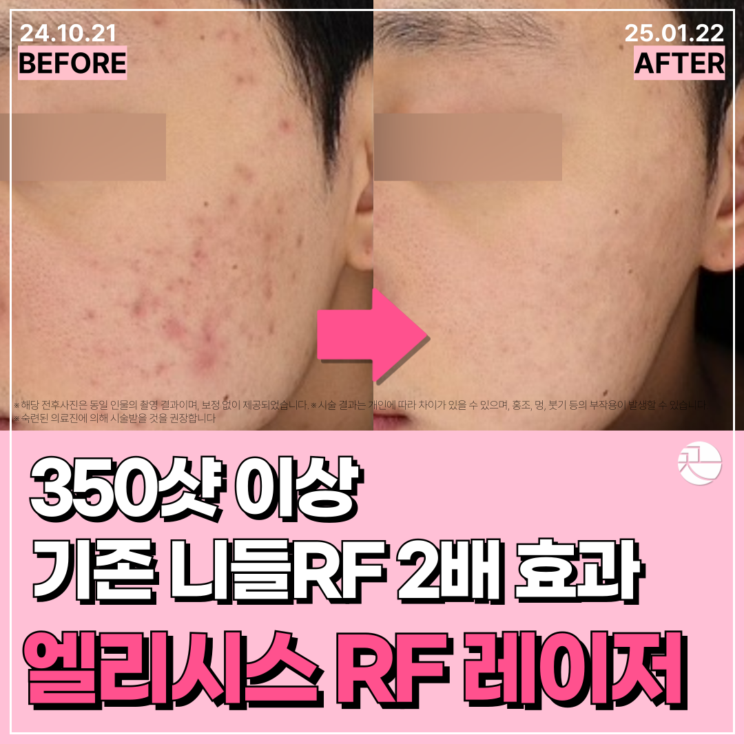 [기존 니들RF 2배 효과, 모공, 여드름 흉터] 엘리시스 RF 레이저