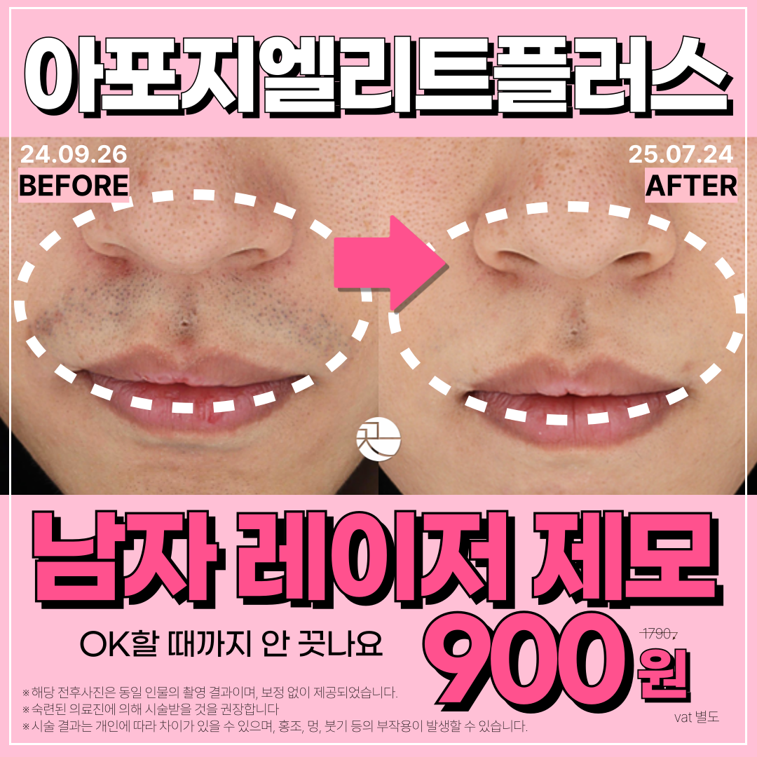 아포지 엘리트 플러스 ! 남자 레이저제모