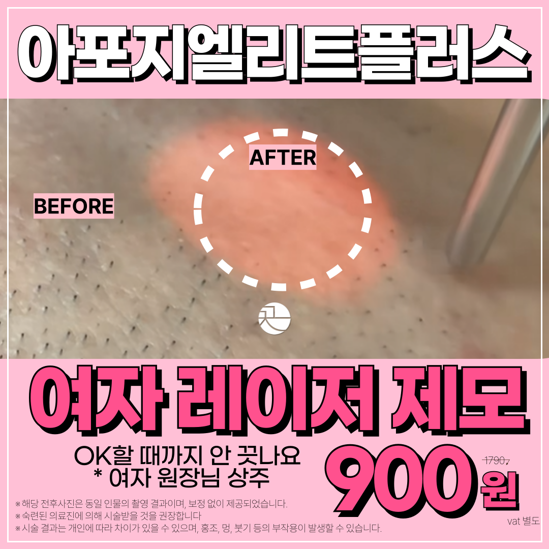 아포지 엘리트 플러스! 여자 레이저제모 (모든 요일 여원장님 상주)