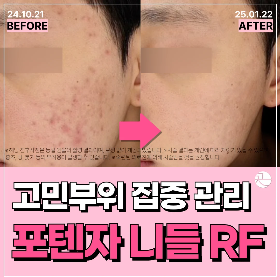 [여드름 흉터, 모공, 잔주름, 피부결 개선] 모공, 여드름 흉터 치료의 여왕 포텐자