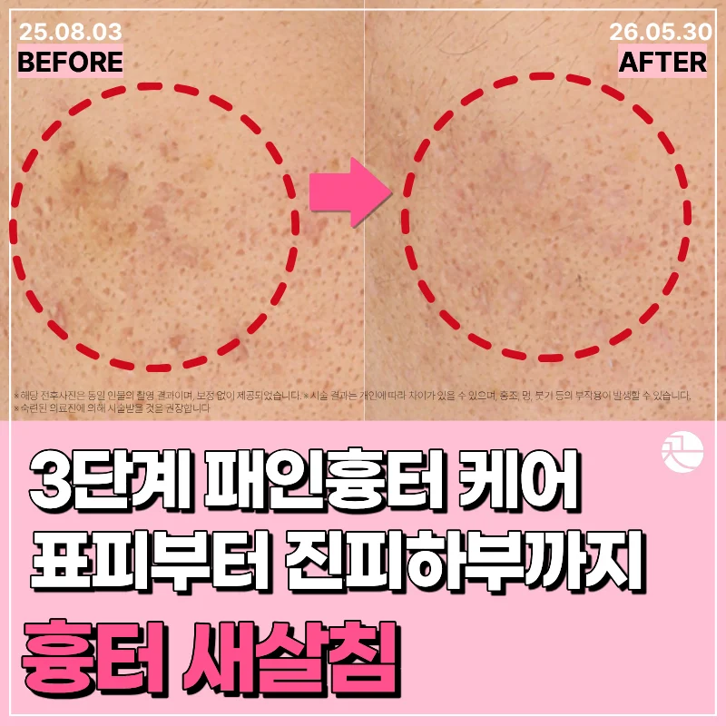 [패인 흉터를 채우는] 흉터 새살침